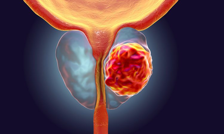 Image result for prostate cancer