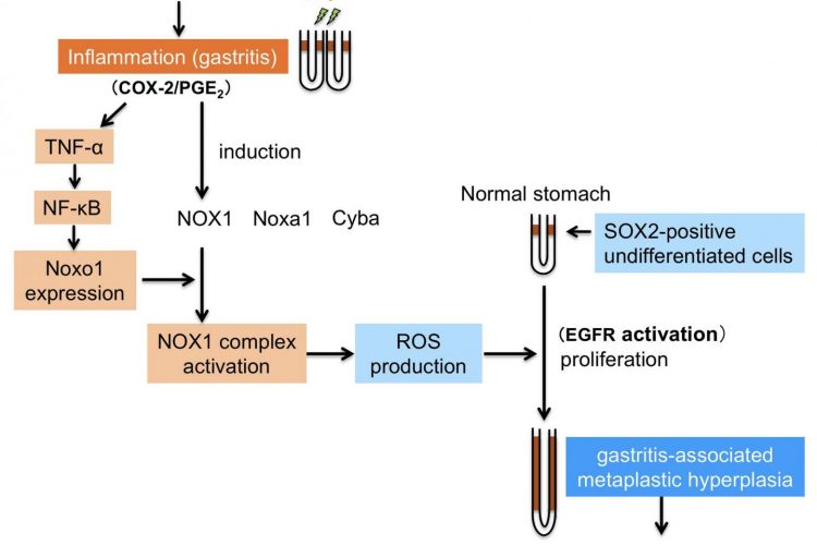 Gastric cancer