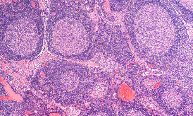 lymph-node-metastasis-in-cancer-progression-molecular-45-off