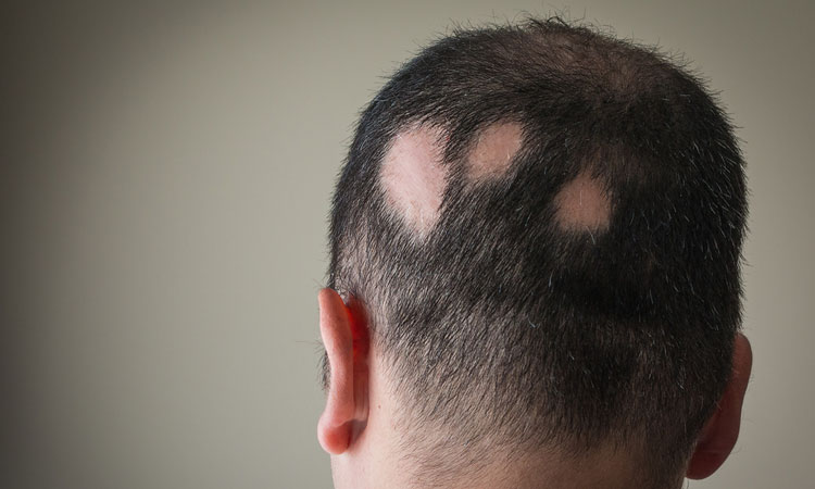 A Wearable Device For Hair Regrowth Drug Target Review