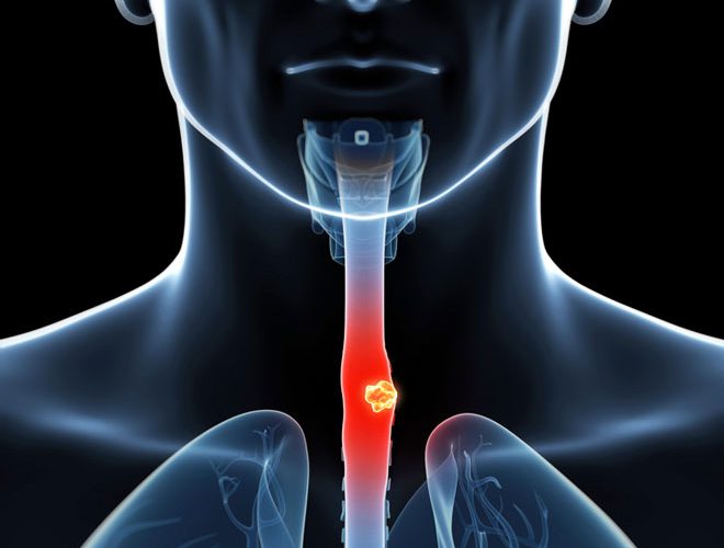 Infra-red light detects early signs of oesophageal cancer