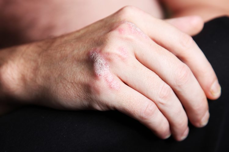 Dating someone with psoriasis