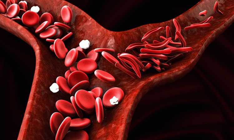 HRI depletion may be effective in treating sickle cell disease